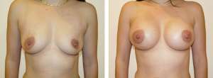 Before & After Patient