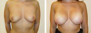 Before & After Patient