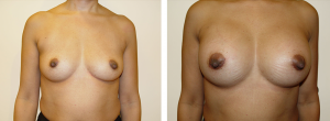 Before & After Patient