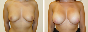 Before & After Patient