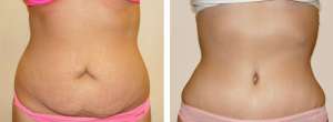 Before & After Patient