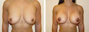Before & After Patient