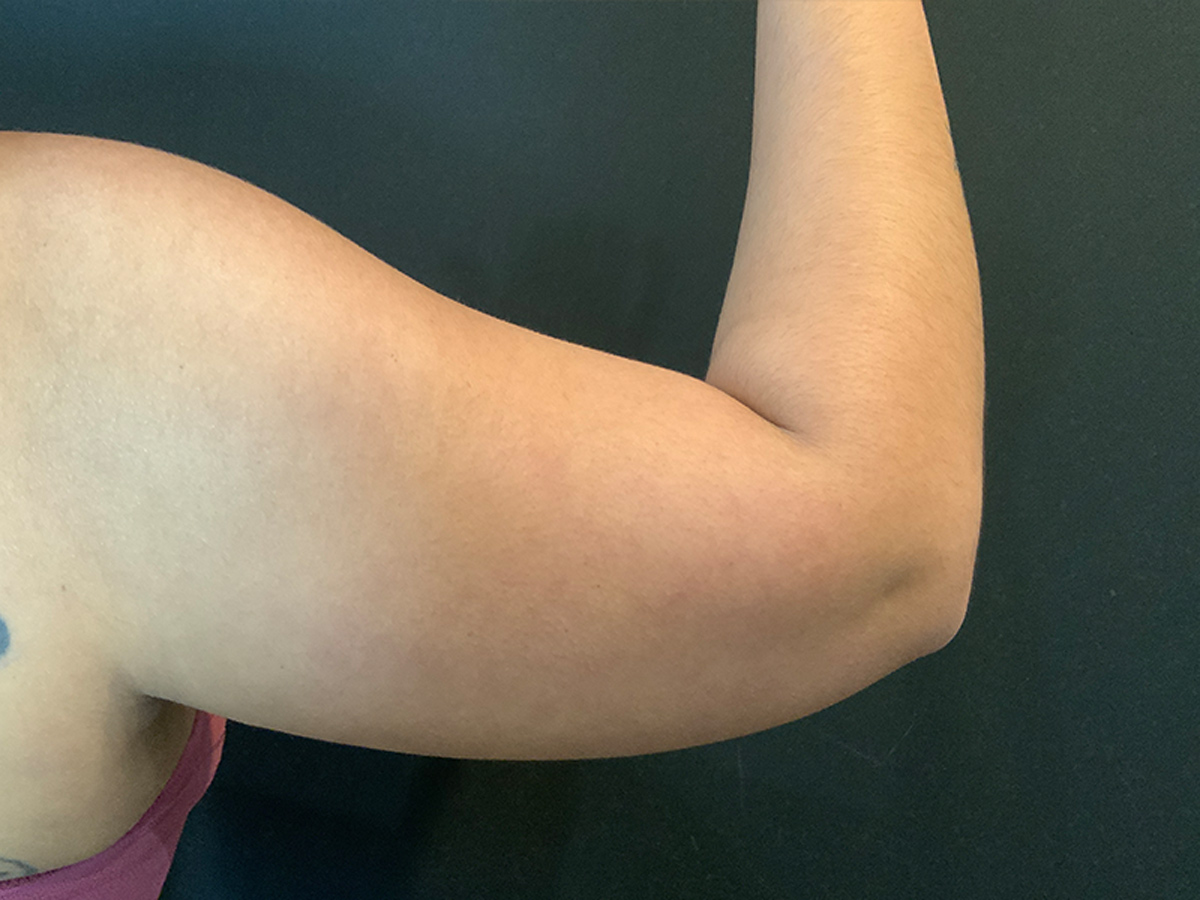 Liposuction to Arms