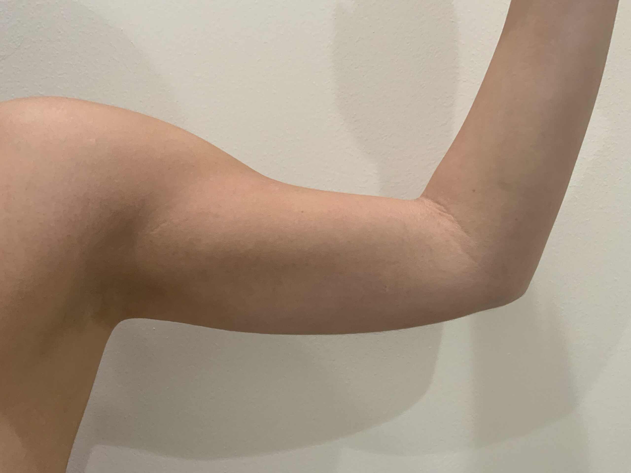 Liposuction to Arms
