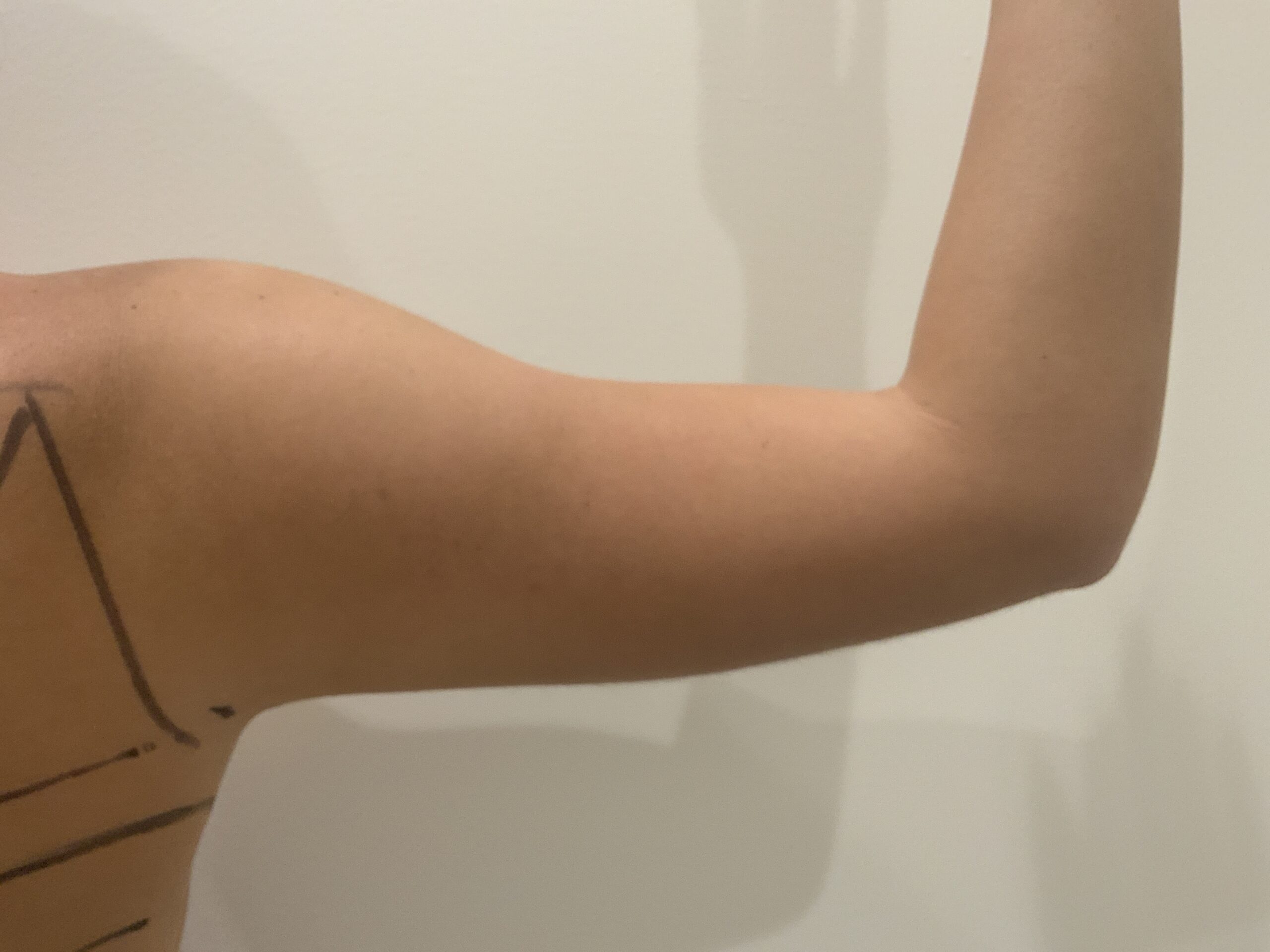 Liposuction to Arms