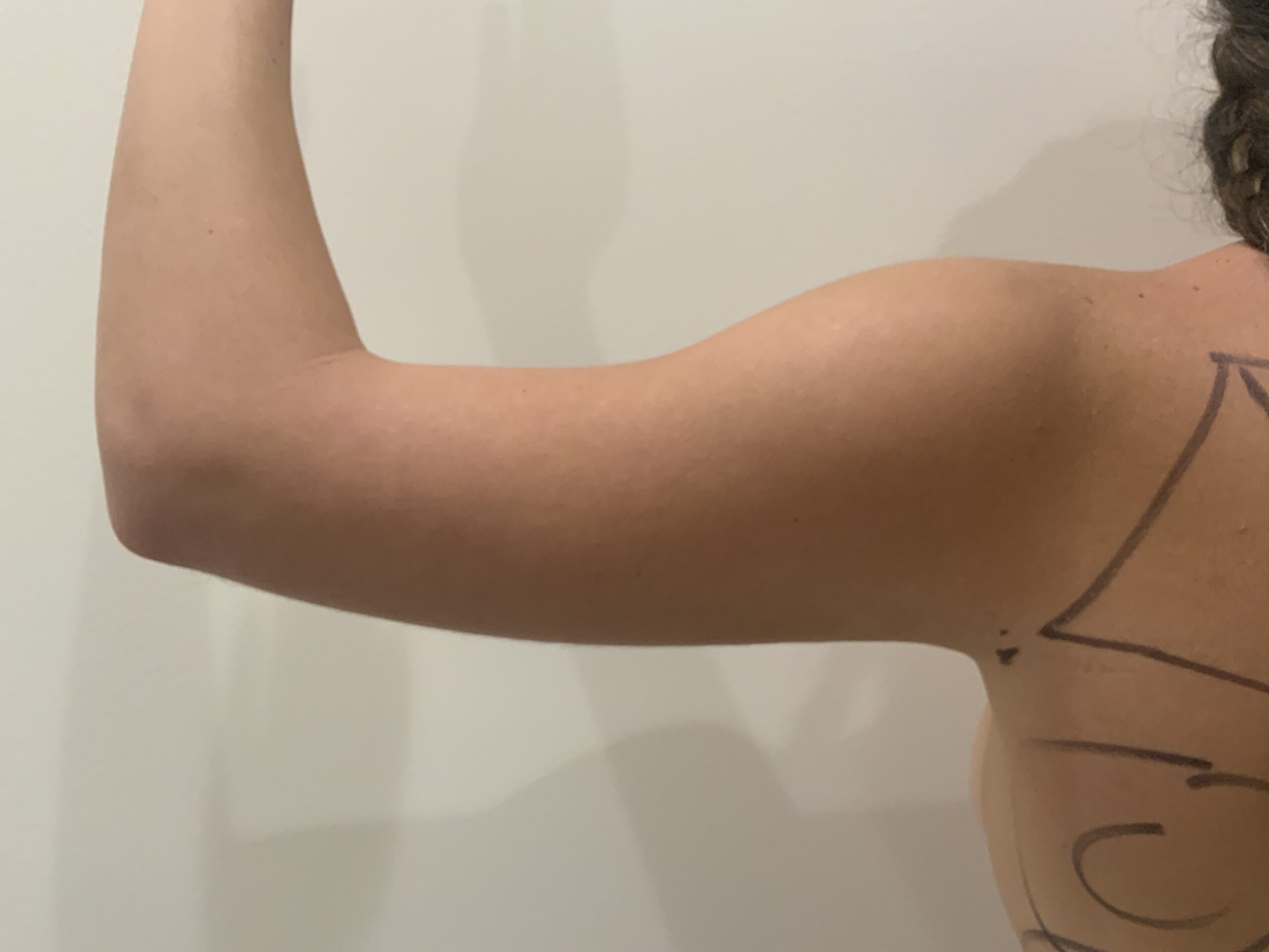 Liposuction to Arms in Orlando