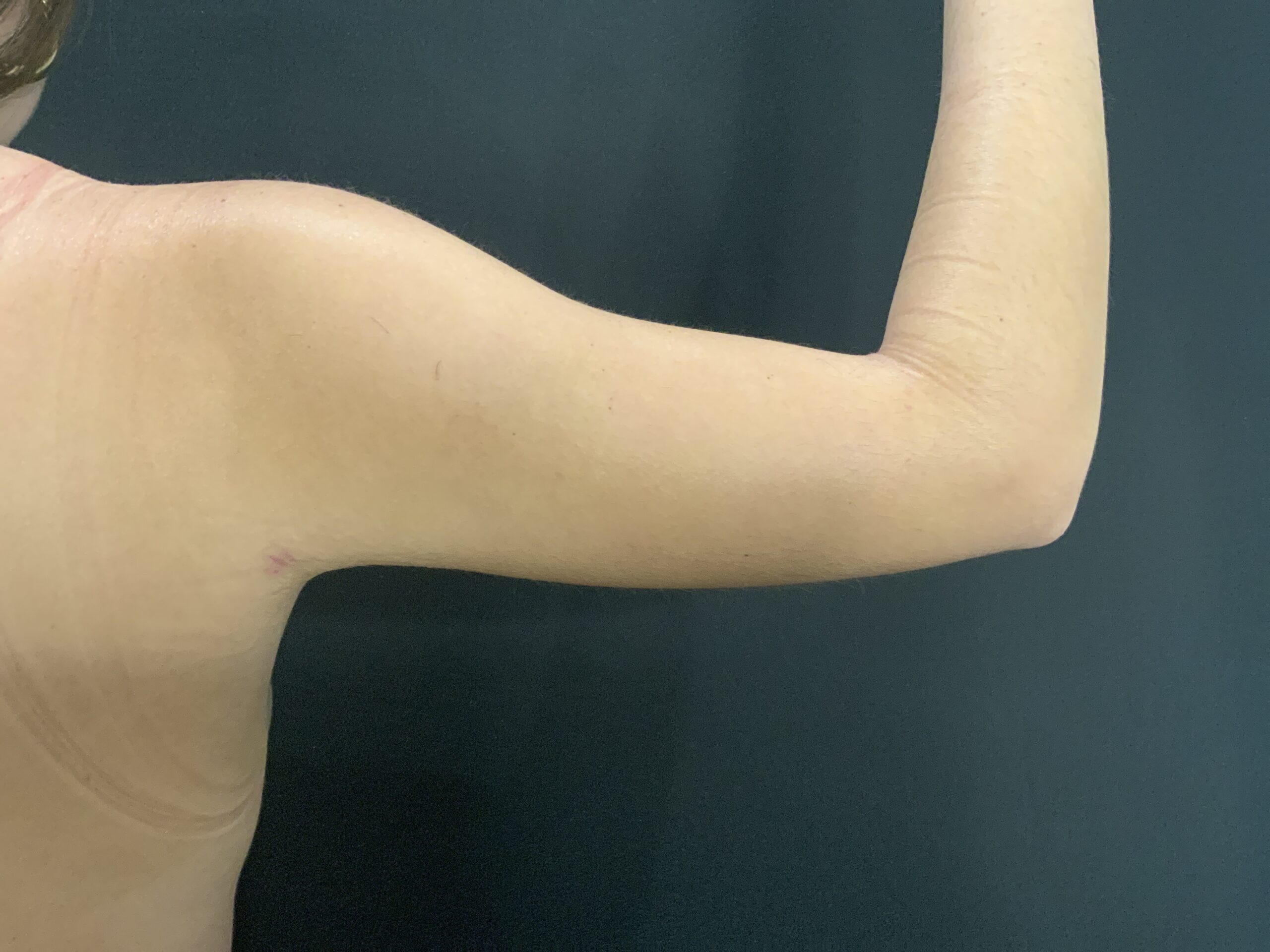 Liposuction to Arms
