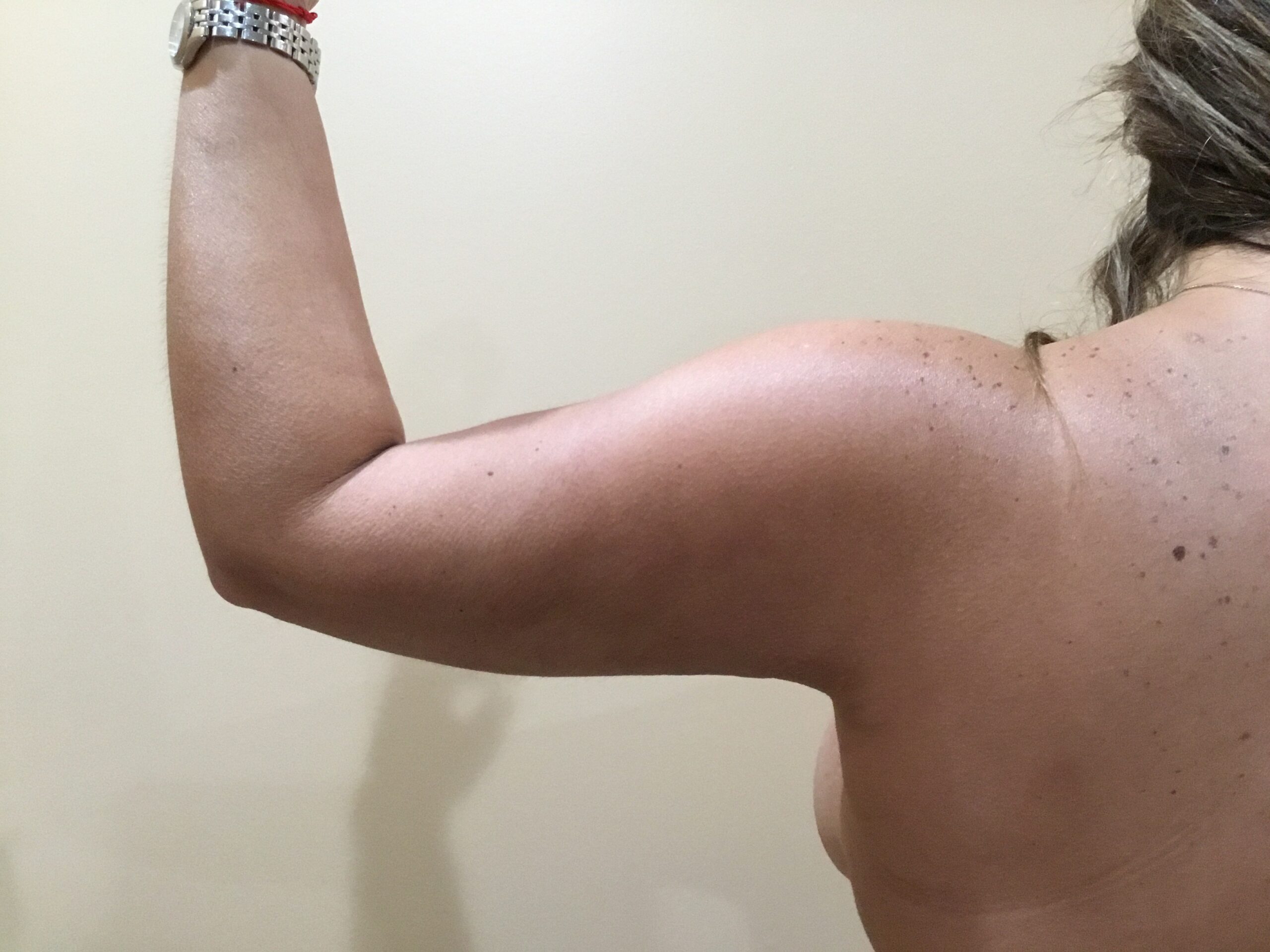 Liposuction to Arms