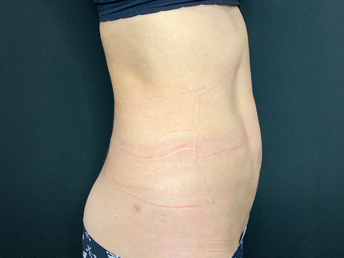 HD Liposuction to Abdomen 