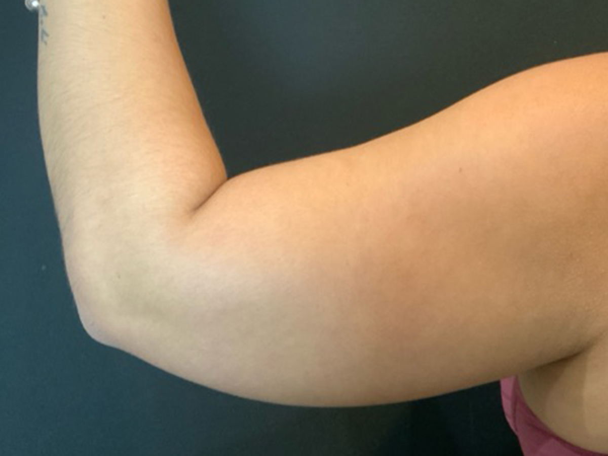 Liposuction to Arms in Orlando