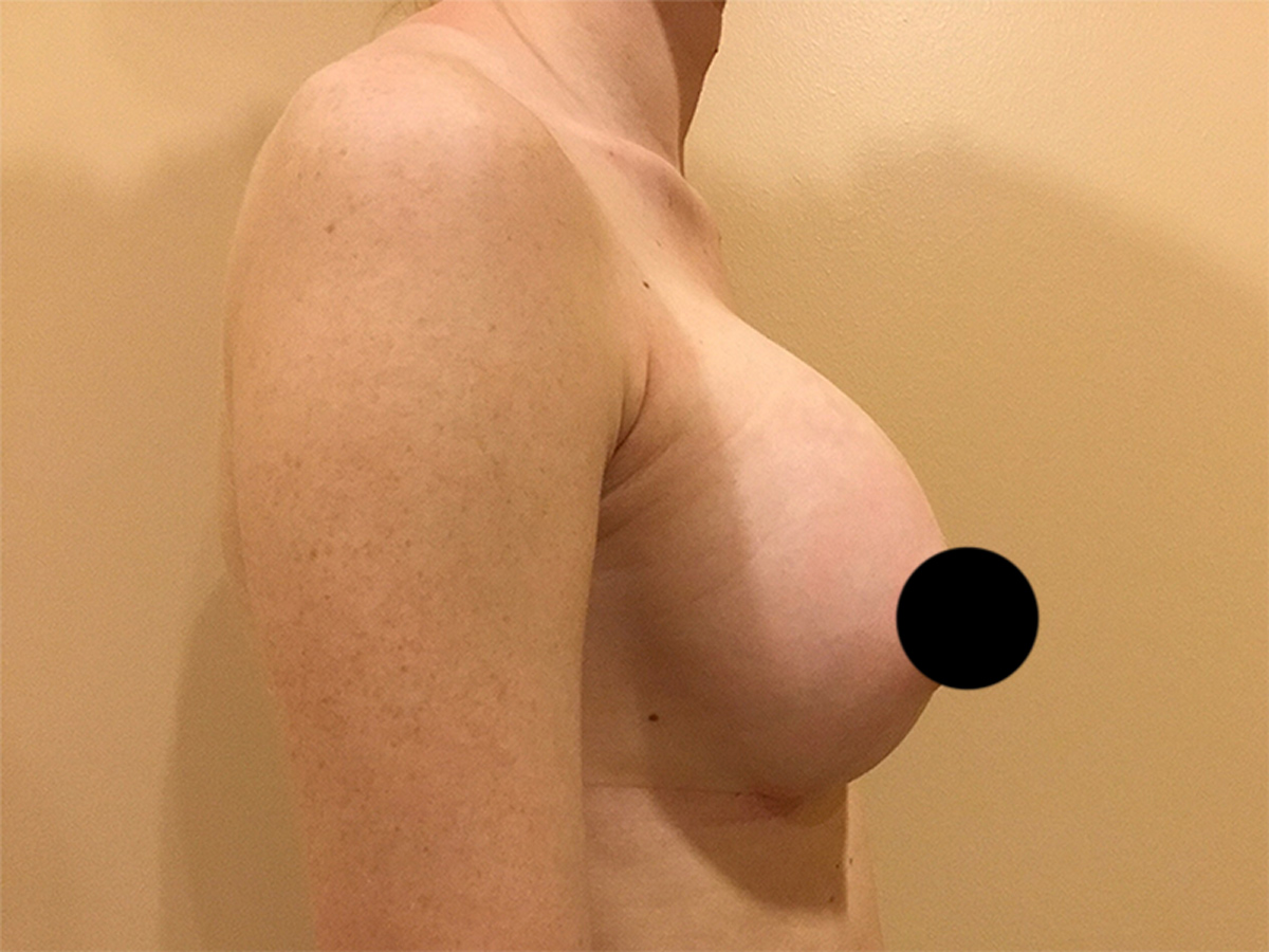 Breast Augmentation