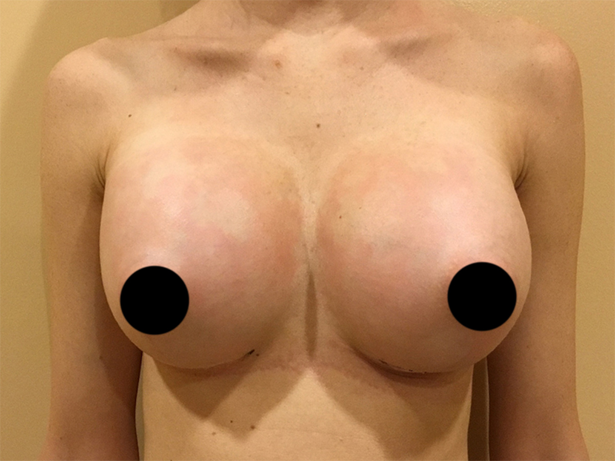 Breast Augmentation