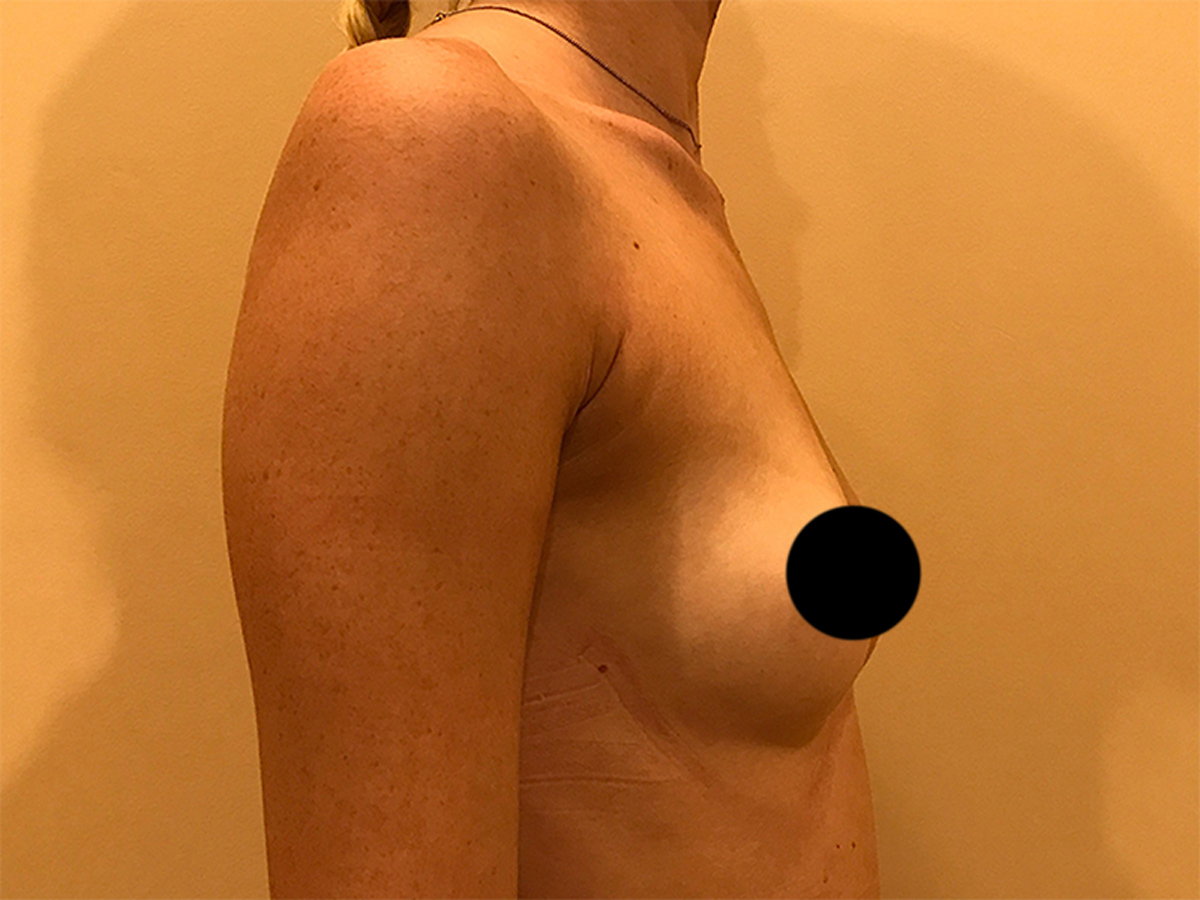Breast Augmentation