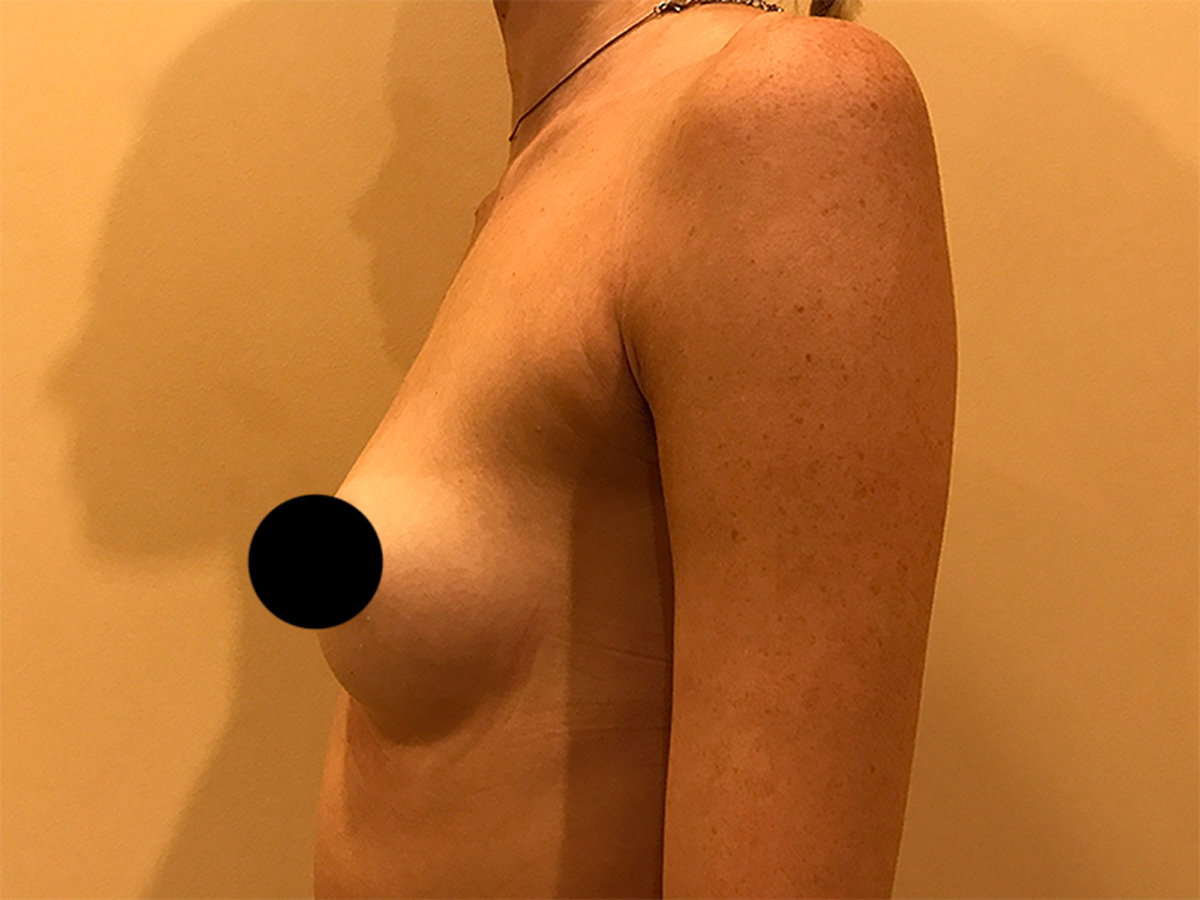 Breast Augmentation