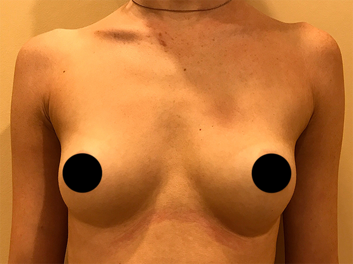 Breast Augmentation in Orlando