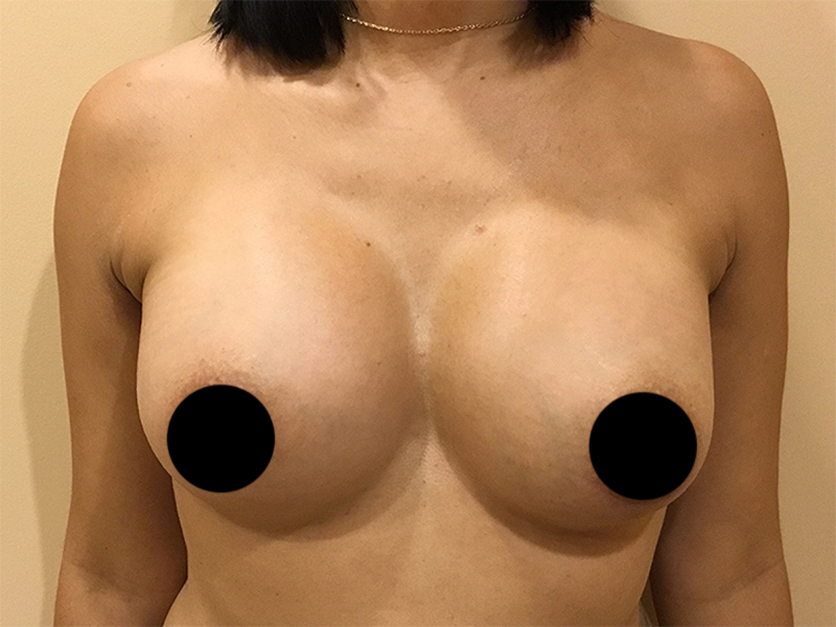 Breast Augmentation