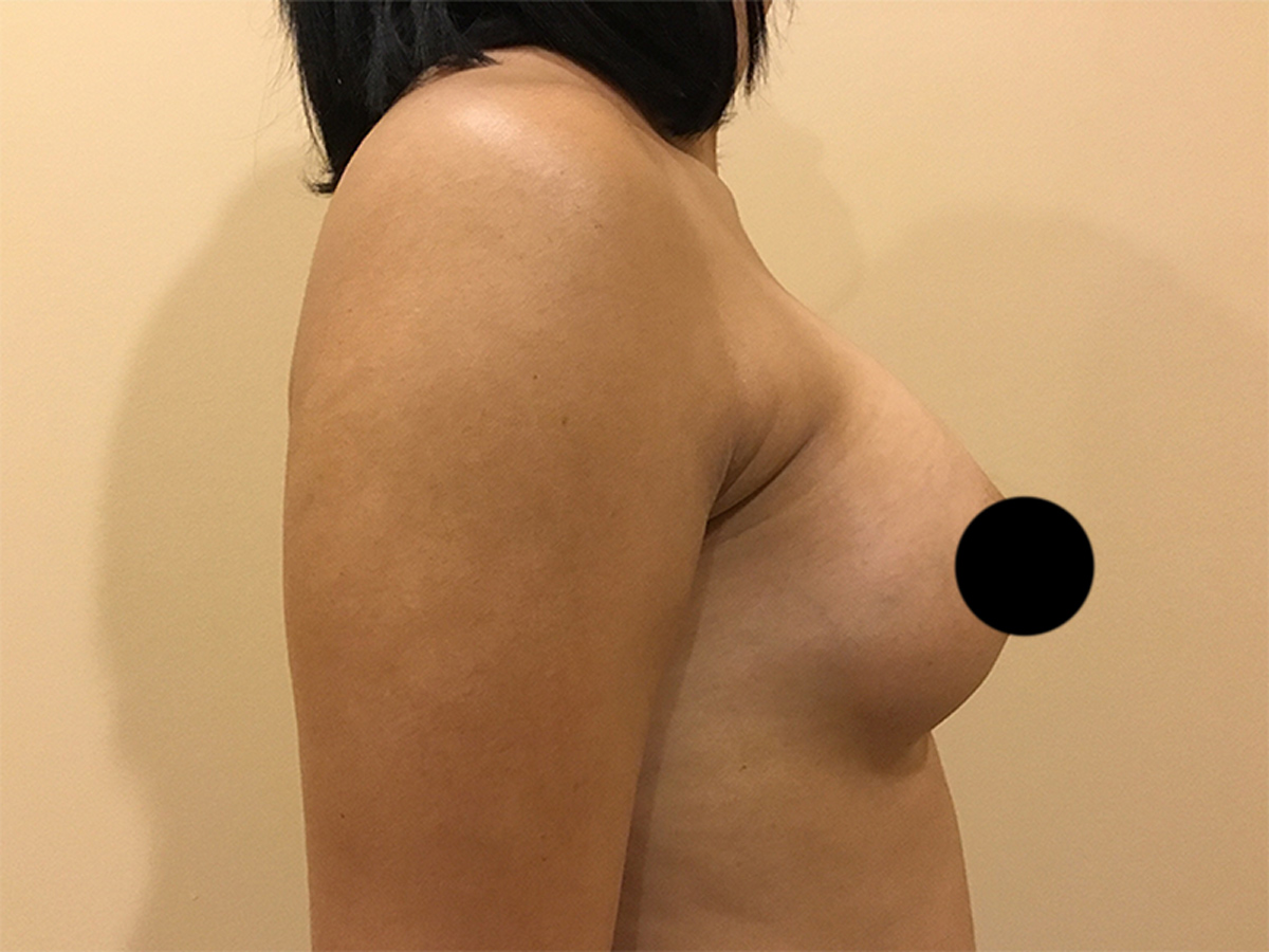 Breast Augmentation