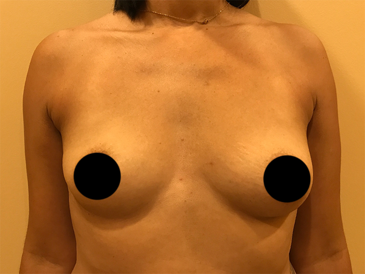 Breast Augmentation in Orlando