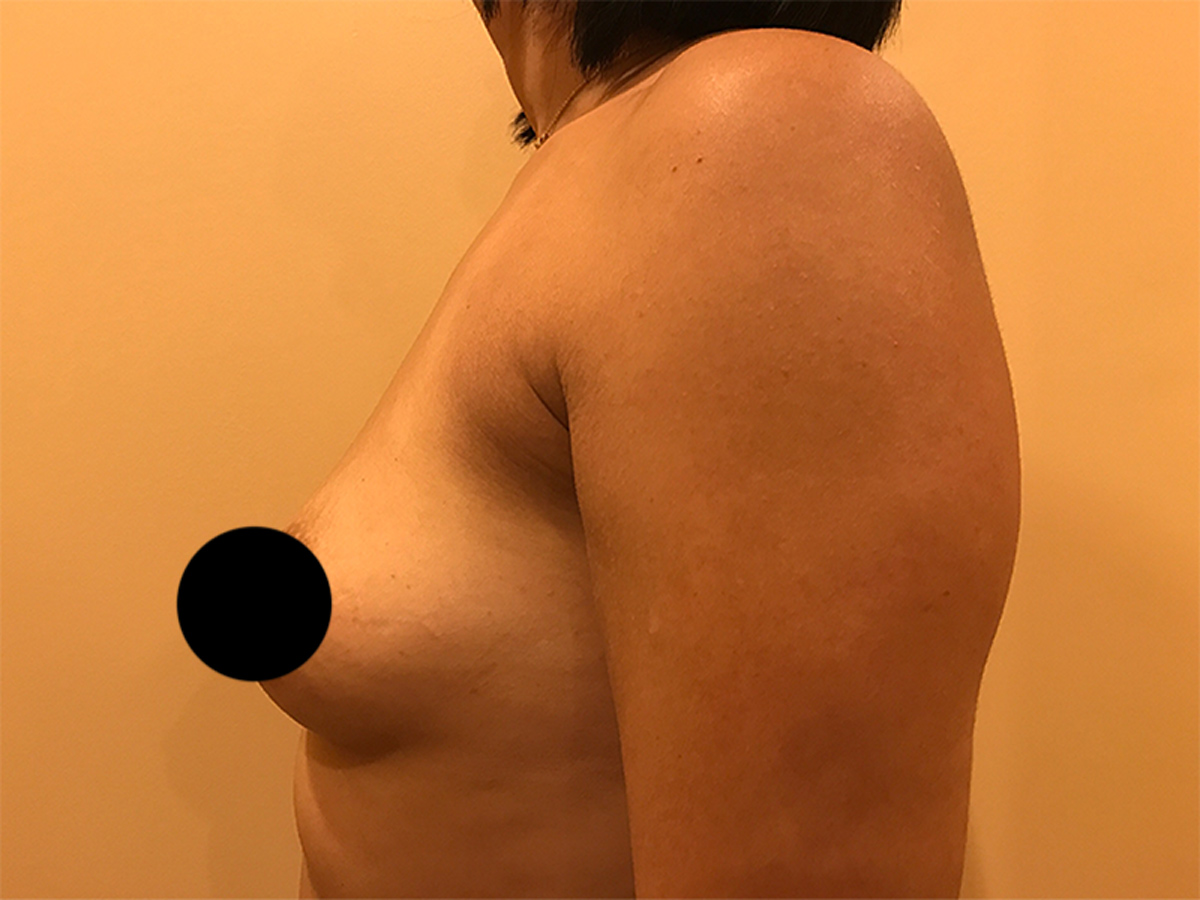 Breast Augmentation