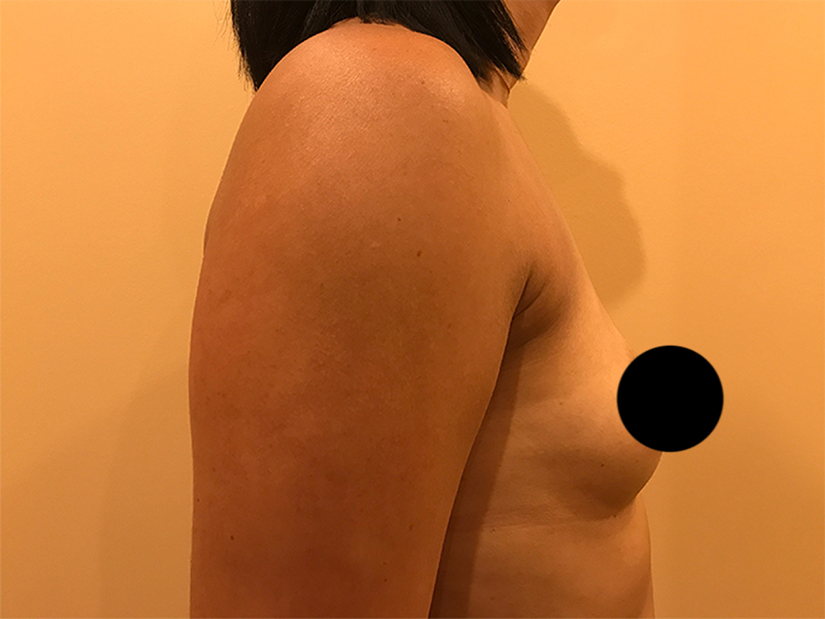 Breast Augmentation