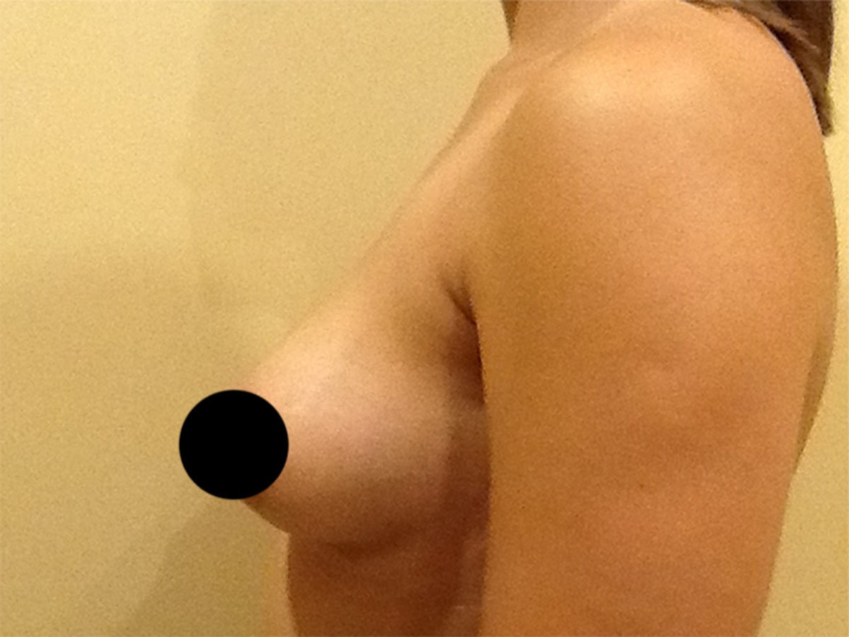 Breast Augmentation