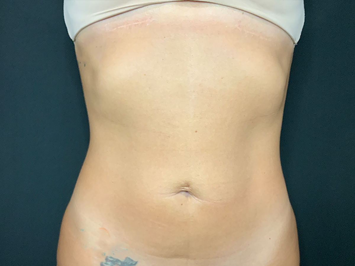 HD Liposuction to Abdomen in Orlando