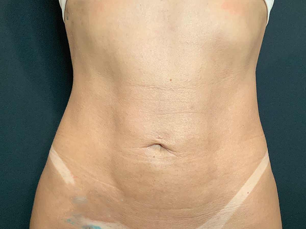 HD Liposuction to Abdomen