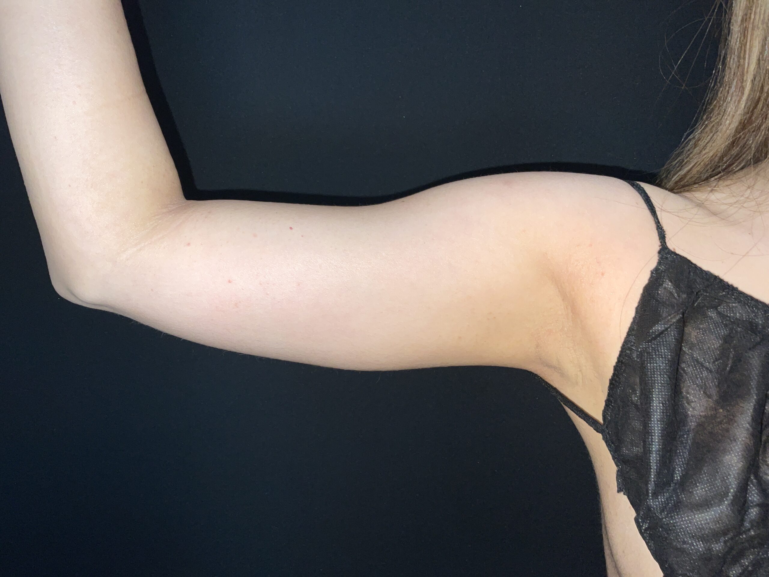 Liposuction to Arms