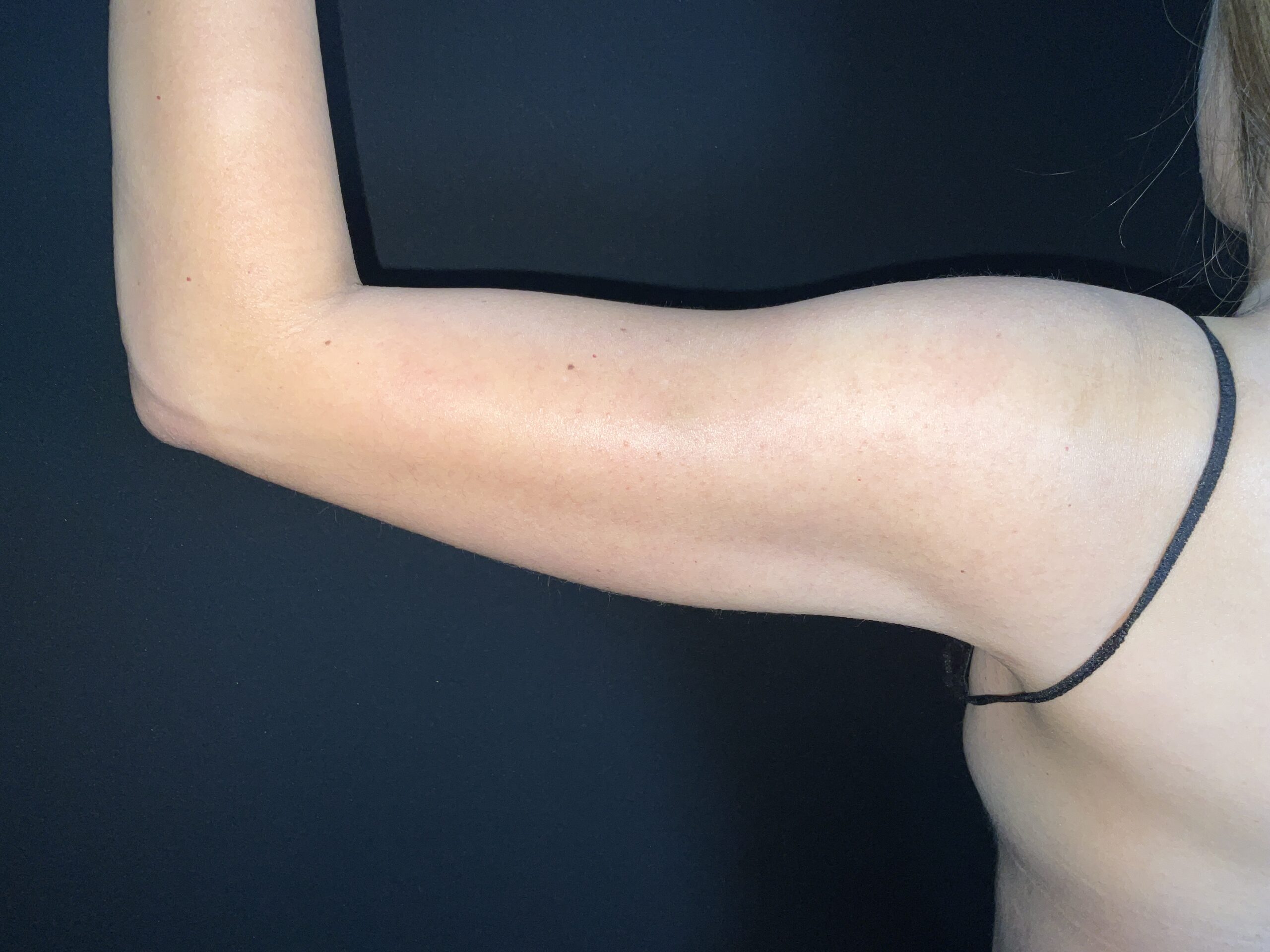 Liposuction to Arms