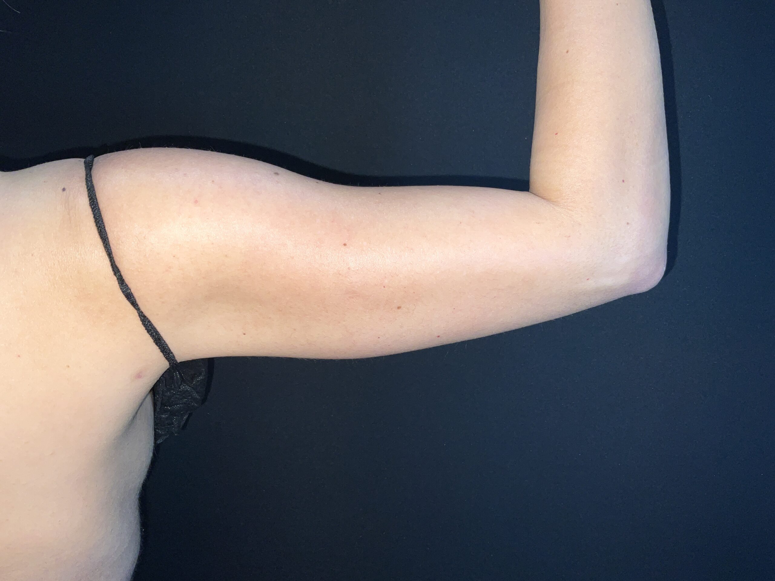 Liposuction to Arms