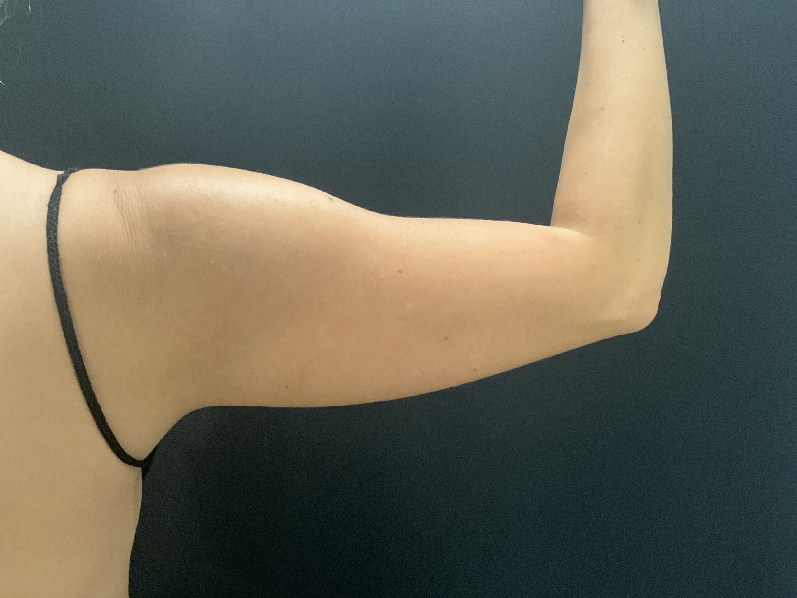 Liposuction to Arms