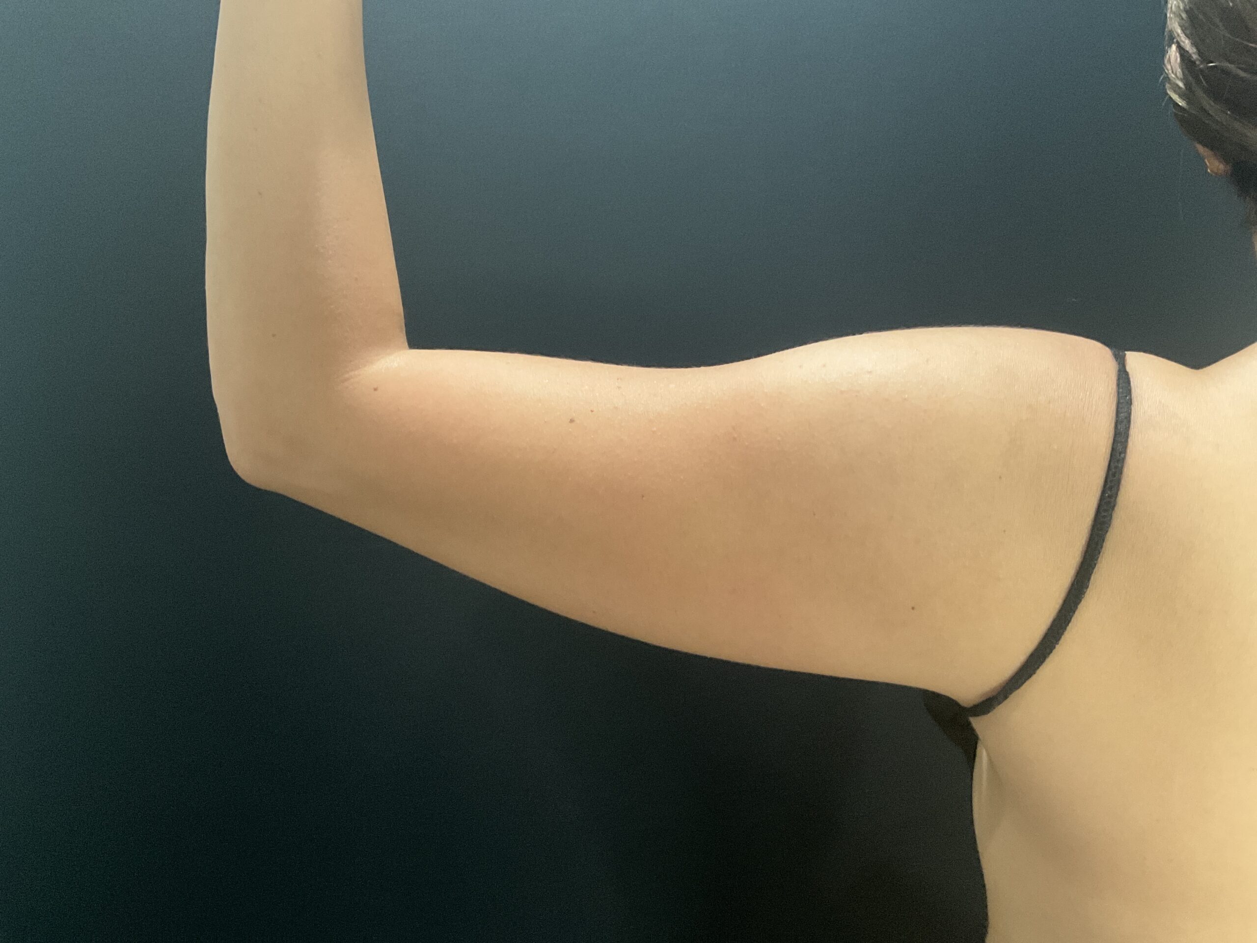 Liposuction to Arms in Orlando