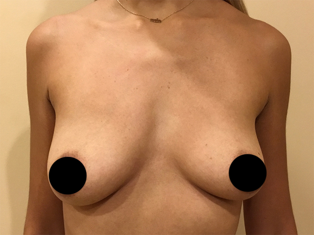 Breast Augmentation in Orlando