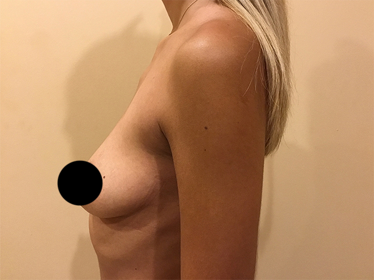 Breast Augmentation