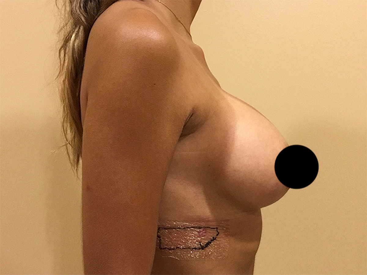 Breast Augmentation