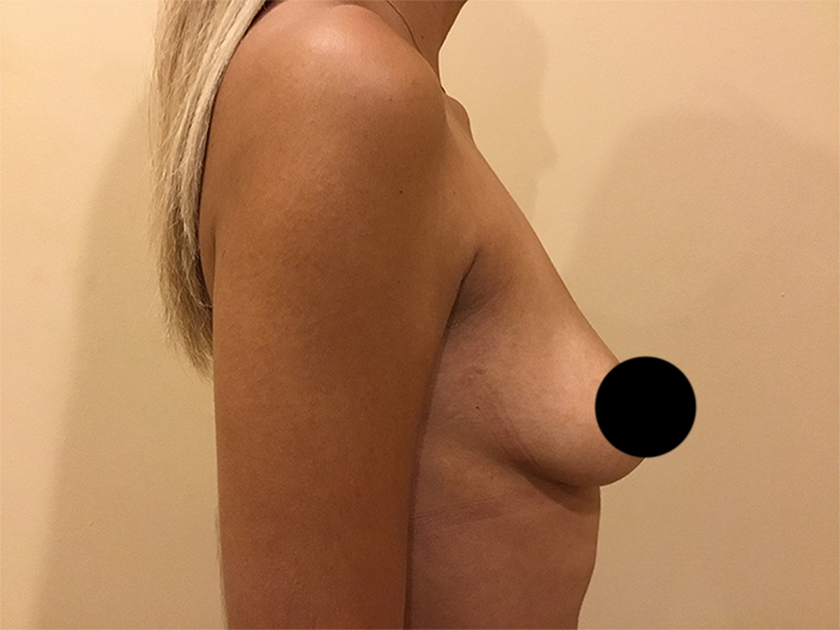 Breast Augmentation