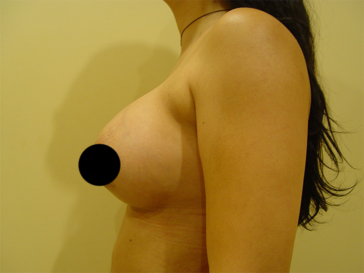 Breast Augmentation