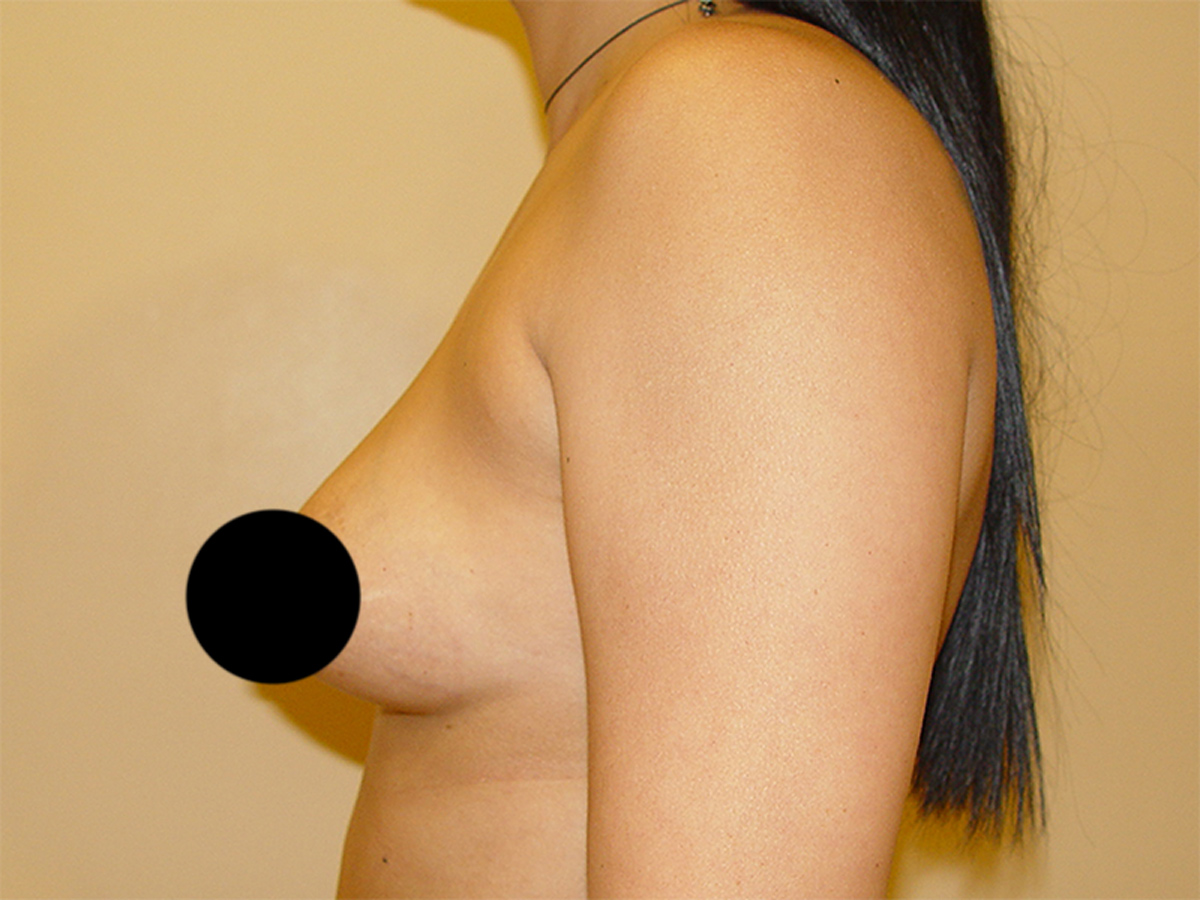 Breast Augmentation