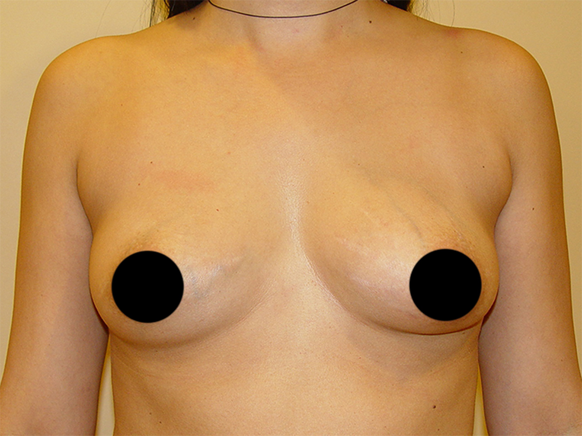 Breast Augmentation in Orlando