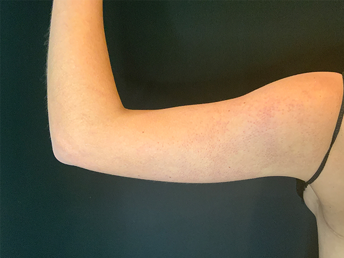 Liposuction to Arms