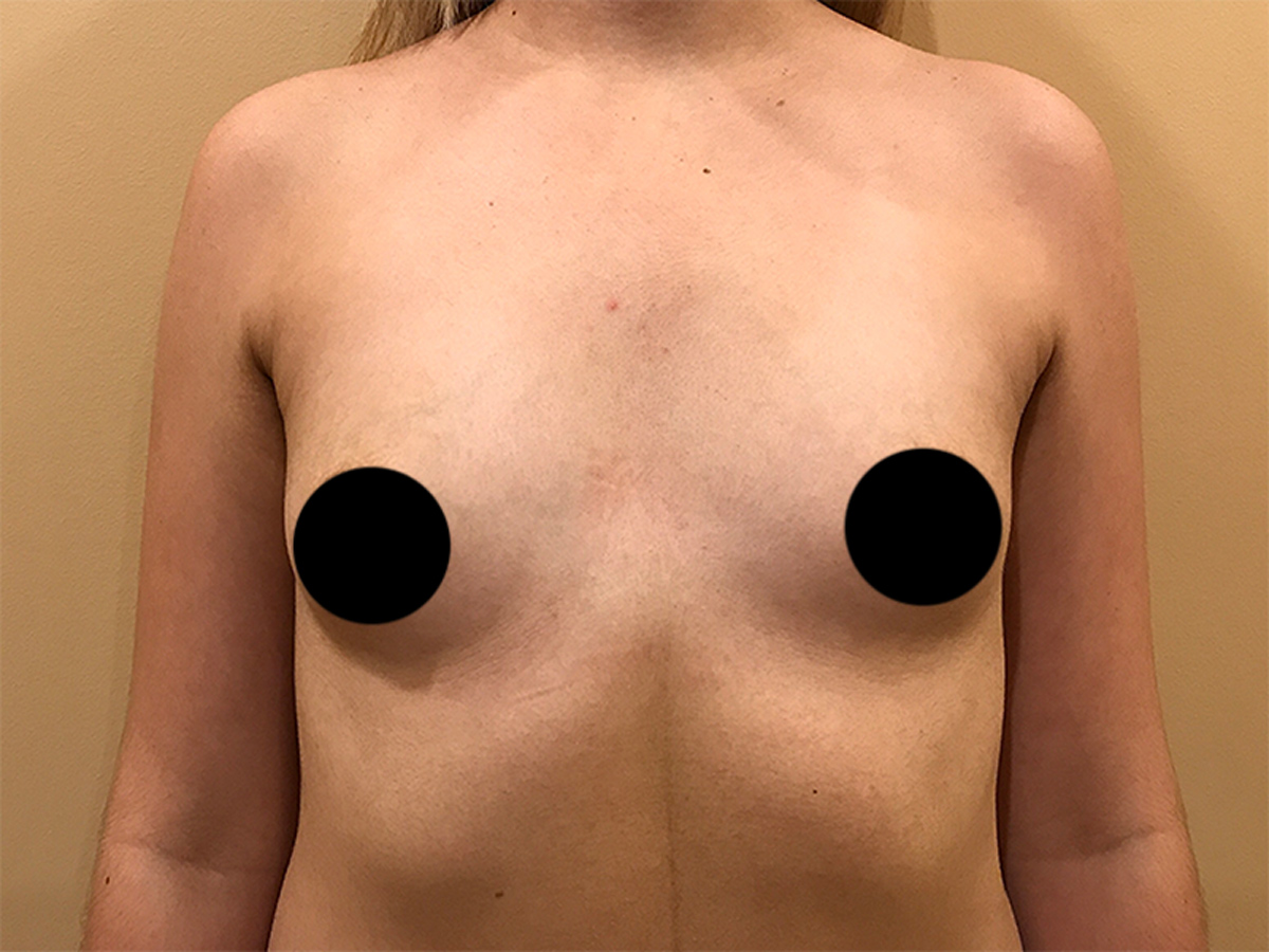 Breast Augmentation in Orlando