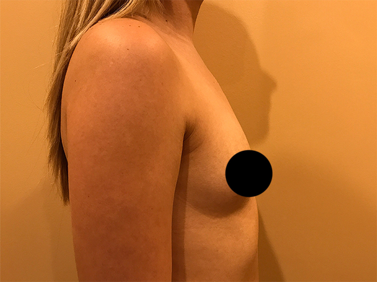 Breast Augmentation