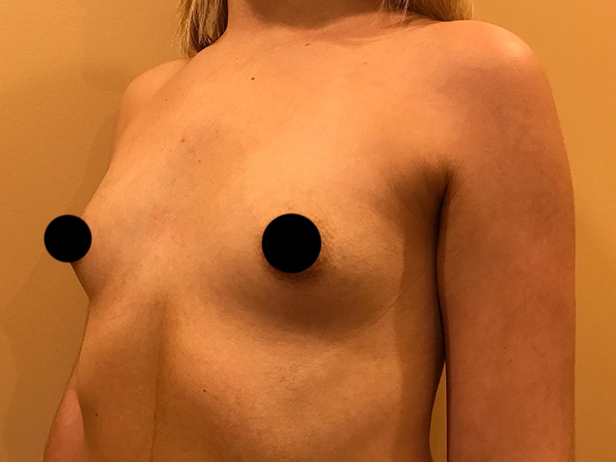 Breast Augmentation