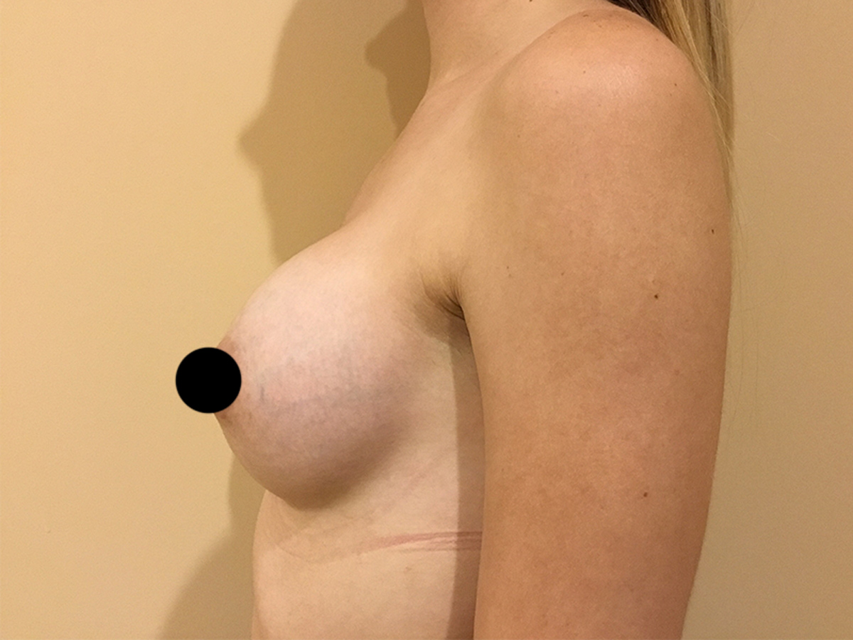 Breast Augmentation