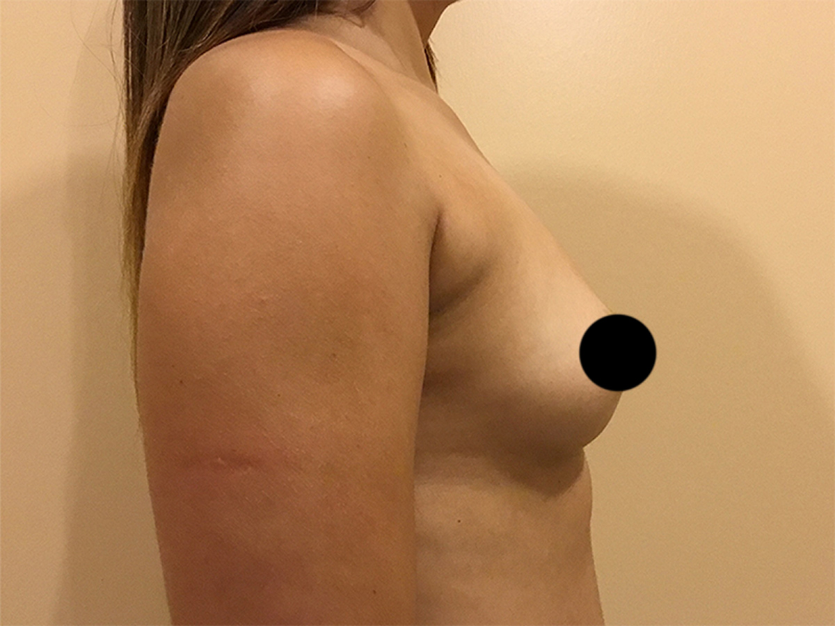 Breast Augmentation
