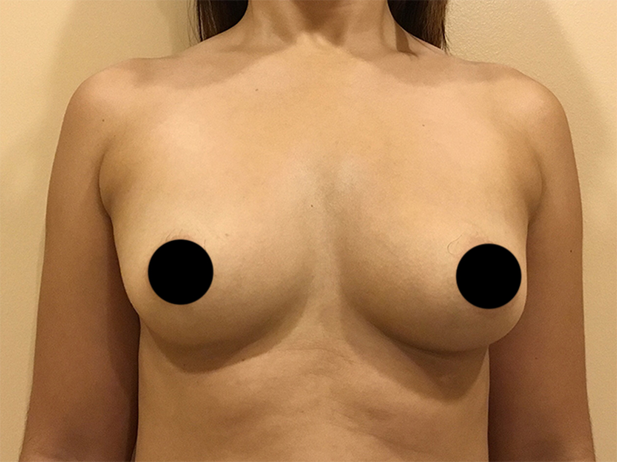 Breast Augmentation in Orlando