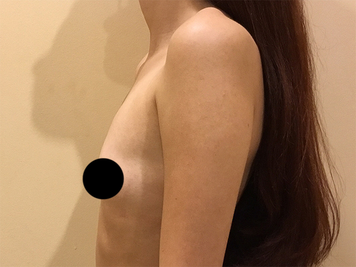 Breast Augmentation