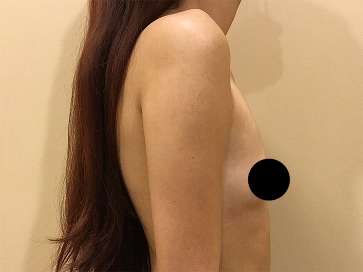 Breast Augmentation