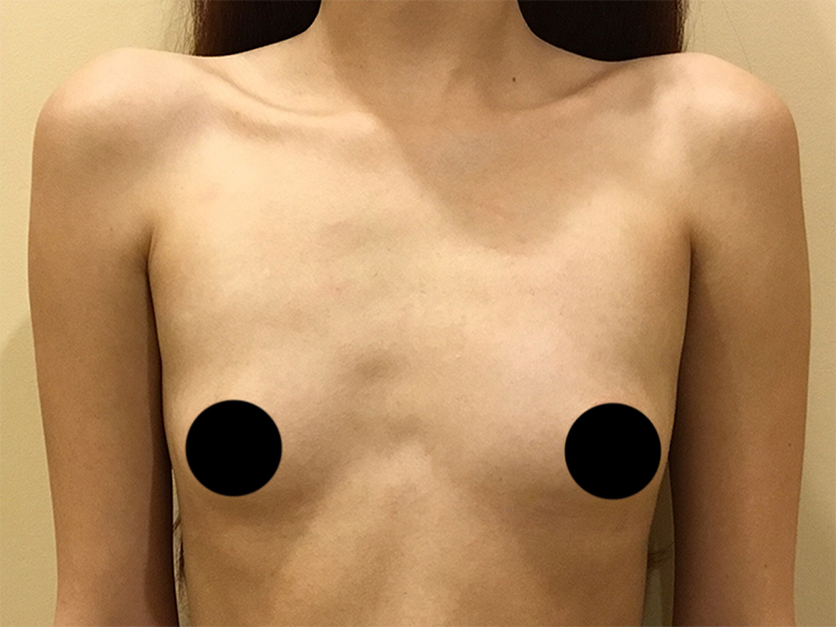 Breast Augmentation in Orlando