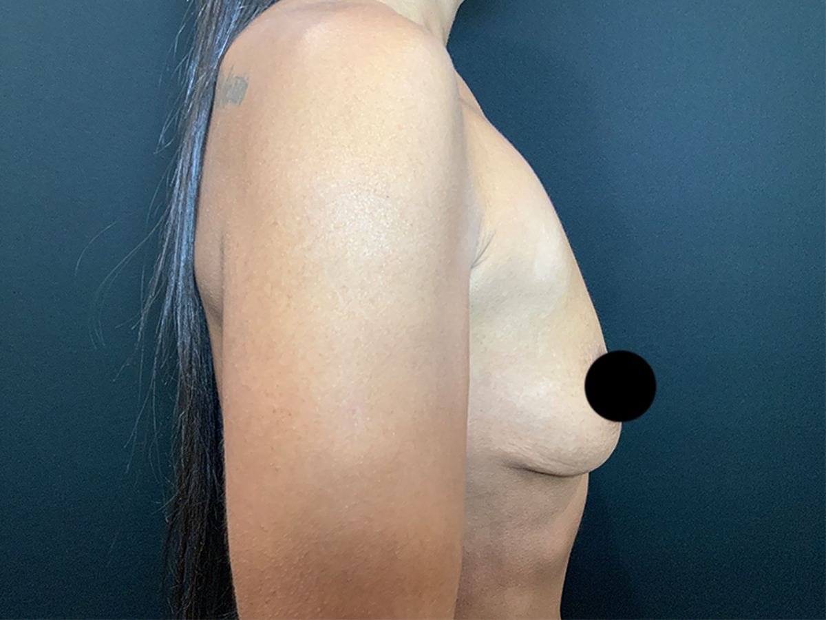 Breast Augmentation